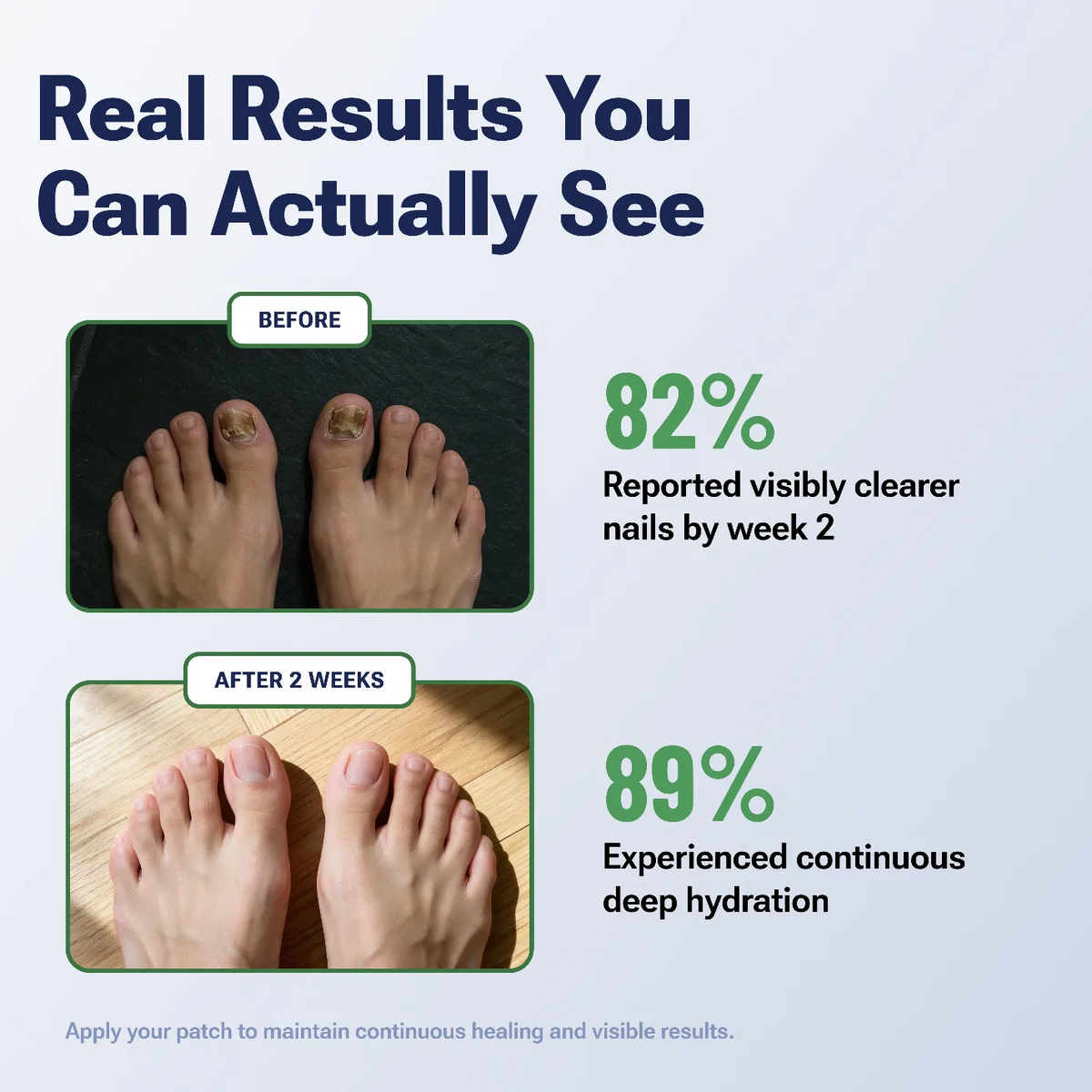 Anti-fungal Nail Patches